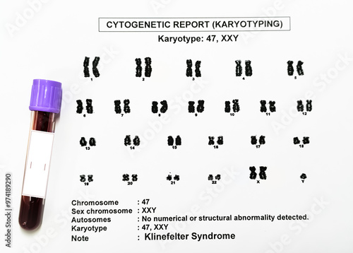 Klinefelter syndrome or KS with karyotyping report and blood sample, KS is a condition where the boys and men are born with an extra X chromosome. Klinefelter's, XXY