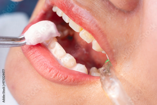 A dental professional using tweezers to apply a medicated paste or fluoride gel onto the patient’s teeth. A saliva ejector is present