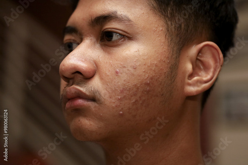 asian boy close up with pimples on cheeks due to allergies and excess androgen hormone.