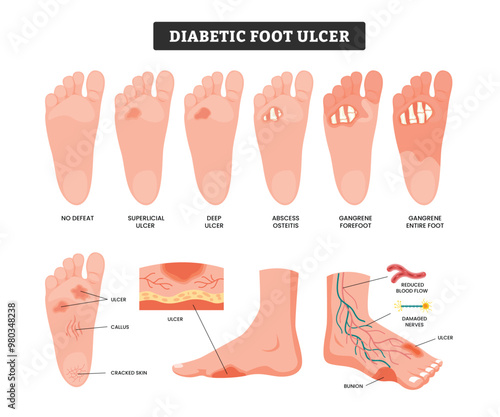 Set of Diabetic Food Ulcer medical infographic healthcare poster design for education, labeled stages of foot ulcer, diabetes gangrene necrosis neuropathy wound necrotizing fasciitis infarction frost