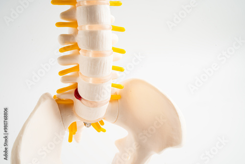 Lumbar spine displaced herniated disc fragment, spinal nerve and bone. Model for treatment medical in the orthopedic department.