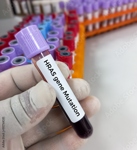 Blood sample for HRAS gene (KRAS and NRAS) test. Costello syndrome, also called faciocutaneoskeletal syndrome or FCS syndrome. a rare genetic disorder