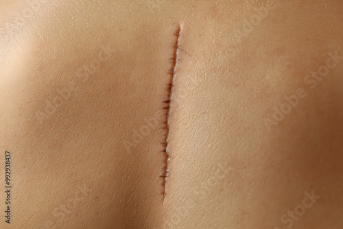 Close-up of skin with a scar from a skin treatment