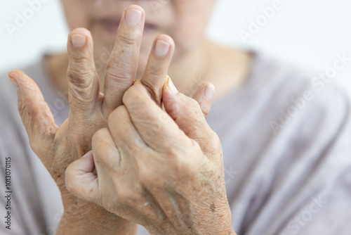 Close up of hands,senior woman suffering from Rheumatoid Arthritis,autoimmune disease,old elderly has pain in her fingers,painful inflammation and stiffness of the joints,chronic progressive disease