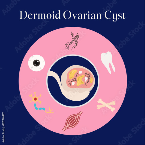 female reproductive system dermoid ovarian cyst consist of illustration