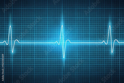 ecg waveform showing normal atrial and ventricular depolarization with high angle