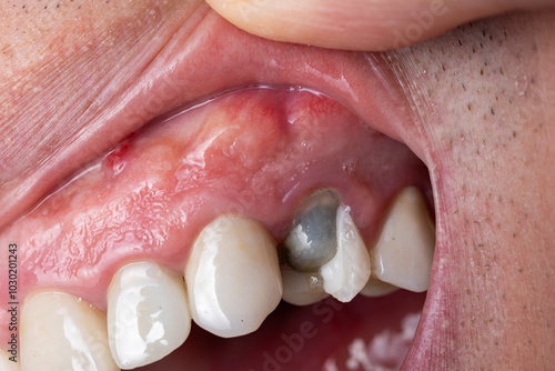 Caucasian male open mouth and teeth with broken upper premolar tooth after dental root canal treatment. Dark gray dental cement before permanent new crown. Close up macro shot