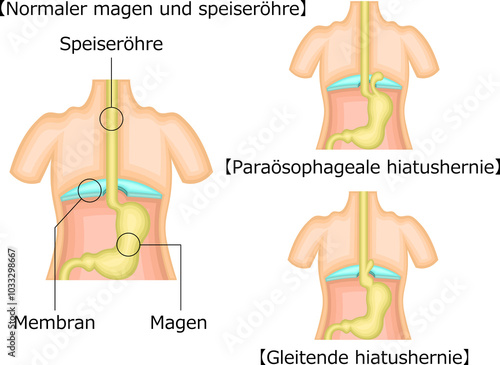 食道 胃 裂孔ヘルニア イラスト ドイツ語