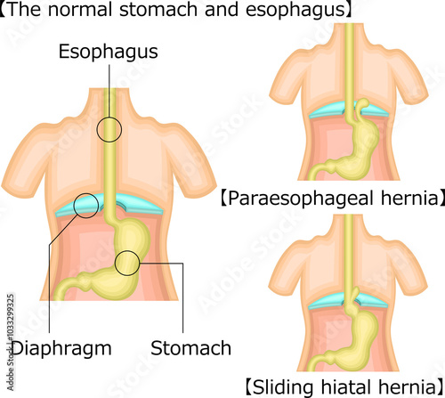 食道 胃 裂孔ヘルニア イラスト 英語