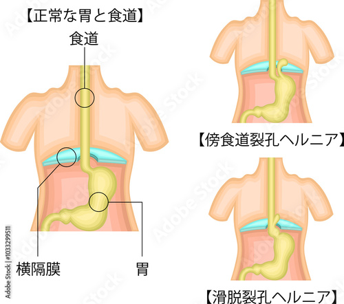 食道 胃 裂孔ヘルニア イラスト 日本語