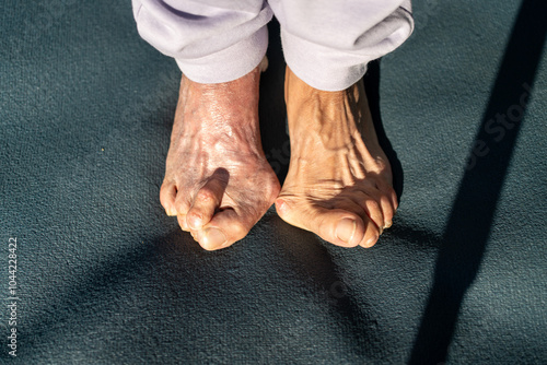 Overhead shot captures feet of senior woman, showing visible effects of bunion and hallux valgus, deformity of MTP joint connecting big toe to foot 