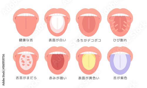 舌の健康状態 種類 イラストセット（説明あり）