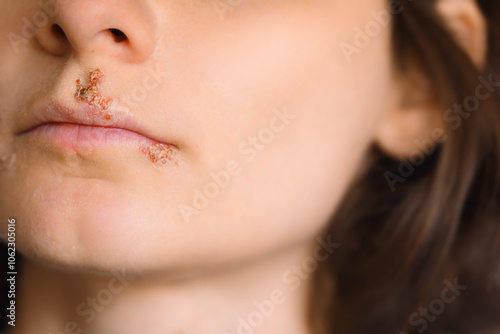 Close up of girl lips affected by herpes. Treatment of herpes infection and virus. Part of young woman face with finger touching pain on lips with herpes affected. Beauty dermatology concept