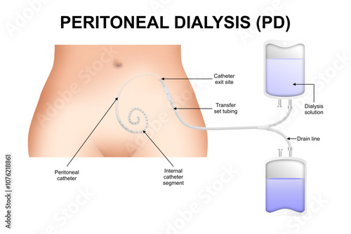 Peritoneal Dialysis (PD) illustration