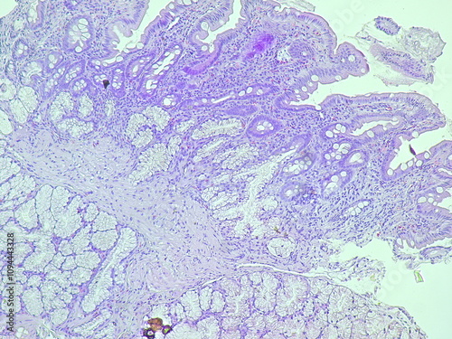 Human cell tissue under microscope in pathology laboratory. Microscopic picture of chronic gastric disease showing Helicobacter pylori bacterial infection, hematoxylin eosin staining