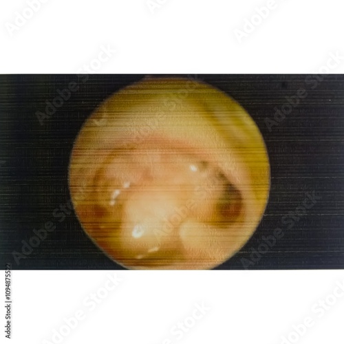 Ear endoscopy. Chronic suppurative otitis media (CSOM). Subtotal perforation of the tympanic membrane.