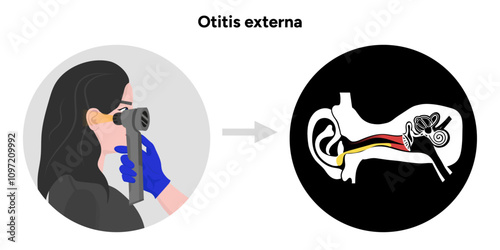 Otitis externa anatomy ear disease inflammation and check up in doctor appointment 