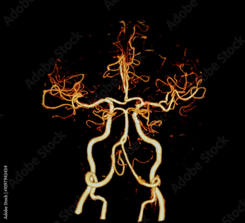 The CT Angiography (CTA) scan of the brain and neck, showcasing the intricate vascular network in vivid detail. It highlights major blood vessels, aiding in diagnosing cerebrovascular conditions.