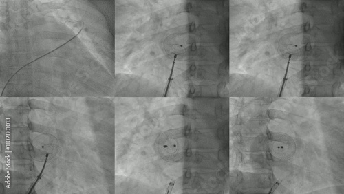 Radiographic Imaging of Atrial Septal Occluder Device Placement During ASD Closure Procedure