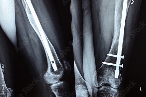 X-ray showing operative interference with intra-medullary nail transfixing LT femoral shaft fracture with ossified callus formation, internal fixation of RT femoral shaft fracture by plate and nails