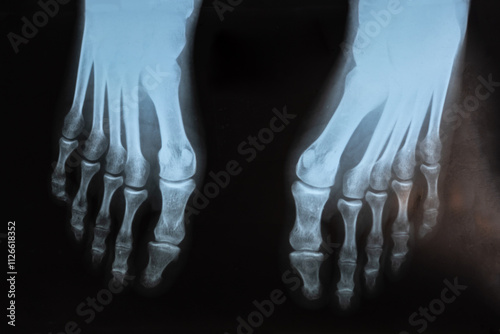 X-ray of human foot. Diseases of the phalanges fingers bones. Metatarsal phalangeal joints.